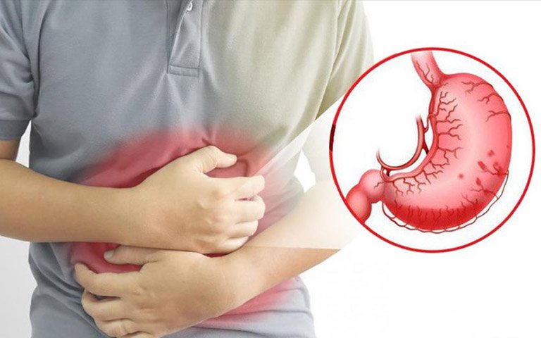 Triệu chứng điển hình của bệnh viêm loét dạ dày là gì?