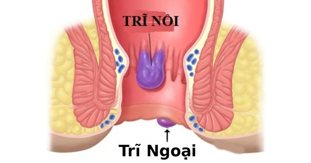 benh-tri