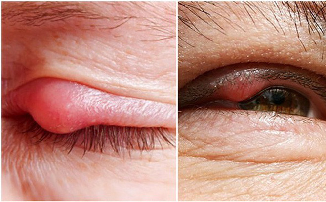 Chắp là một u hạt xuất phát từ tuyến của sụn mi bị bít tắc xảy ra do tuyến nhờn mebomius trên mí mắt bị tắc và viêm nhiễm