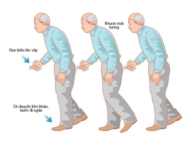 Bệnh Parkinson hay xảy ra ở người già hoặc trung tuổi