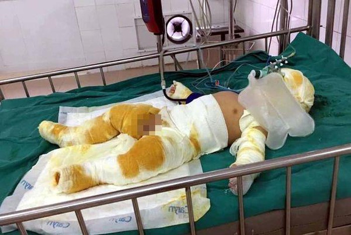 Cháu Nguyễn Hải Nam, con trai anh Mạnh bị bỏng nặng, đã được chuyển về Viện Bỏng 