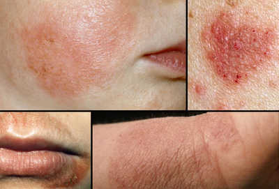 Eczema là bệnh viêm da dị ứng khá phổ biến hiện nay
