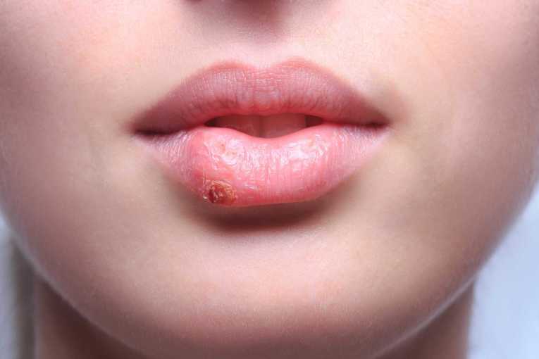 Thuốc Acyclovir 800mg điều trị nhiễm virus herpes simplex ở da