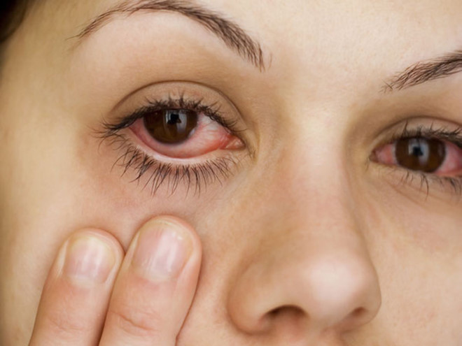 Tình trạng đau mắt đỏ là nguyên nhân gây bọng mắt