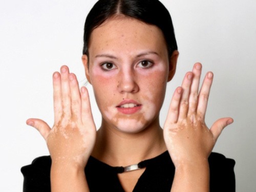 Bệnh bạch biến khiến cho các mảng da của bạn bị mất màu sắc