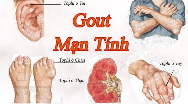 Bệnh gout gây ra nhiều cơn đau đớn cho bệnh nhân