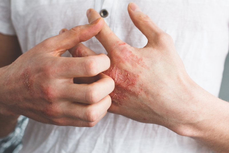 Acyclovir có thể làm giảm các triệu chứng nhiễm trùng trên da