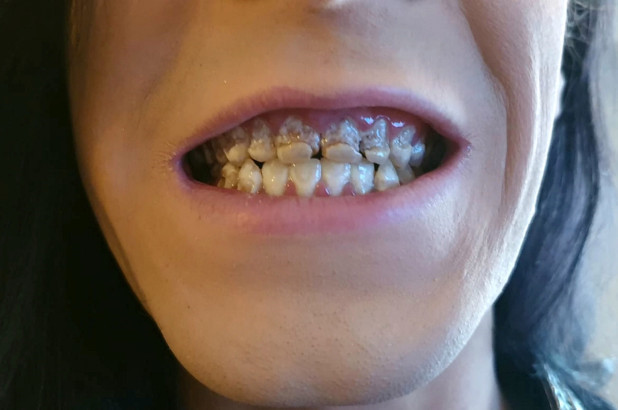 Hàm răng hoàn toàn bị mục nát sau khi uống quá nhiều nước tăng lực