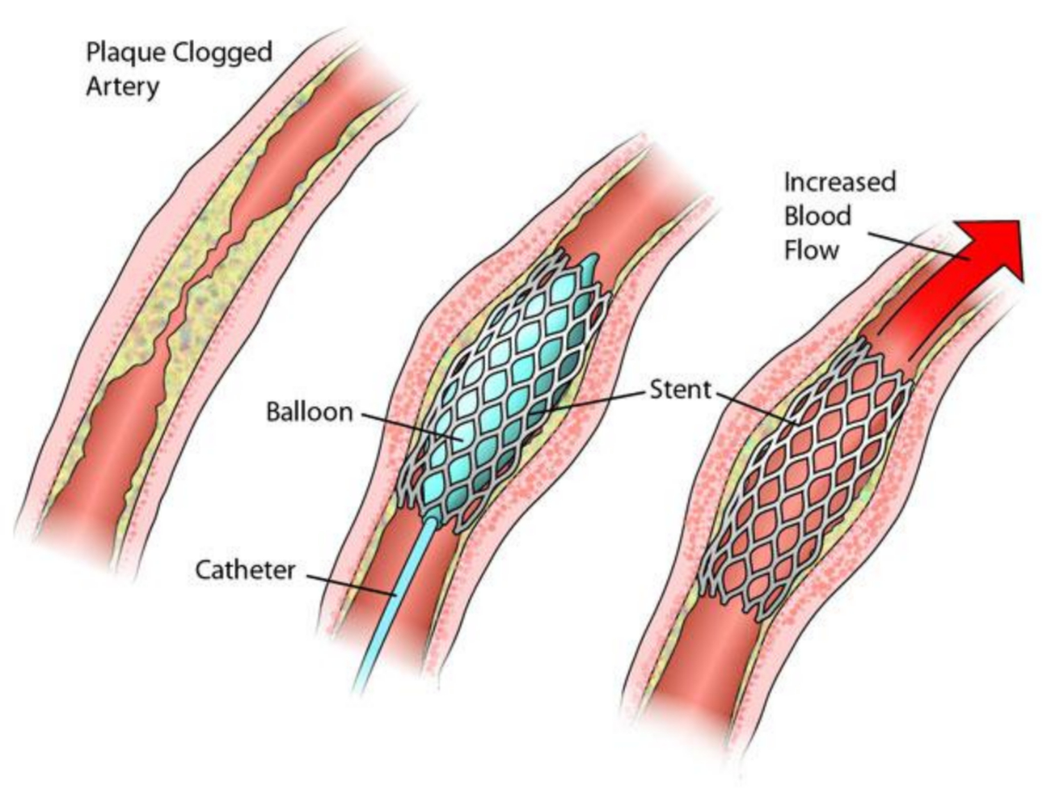 stent mạch cảnh 