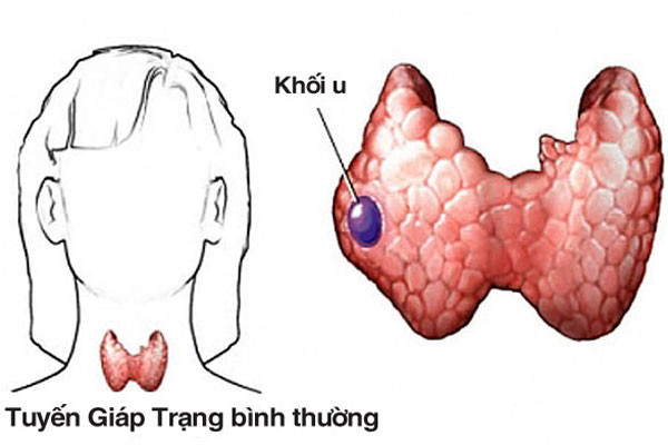 Bướu tuyến giáp kiêng ăn gì ?