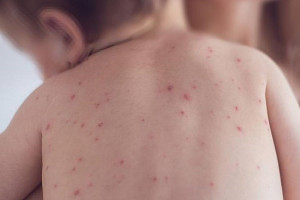 be-moi-hon-1-tuoi-da-mac-sui-mao-ga-vi-lay-benh-tu-bo