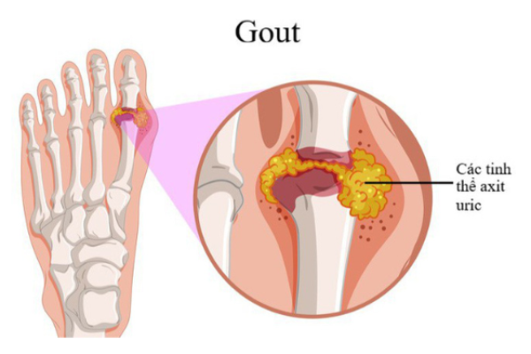 Bệnh gout: Nguyên nhân biểu hiện và cách điều trị
