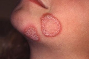 benh-hac-lao-co-lay-nhiem-khong-cach-chua-nhu-the-nao