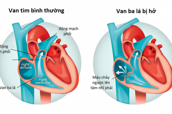 Bệnh Hở van tim 3 lá có nguy hiểm không? Cách điều trị bệnh ra sao?