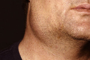 benh-quai-bi-la-gi-dieu-tri-quai-bi-nhu-the-nao