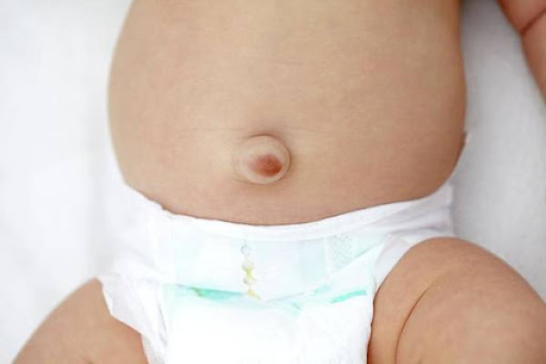 Bệnh thoát vị rốn được điều trị thế nào?