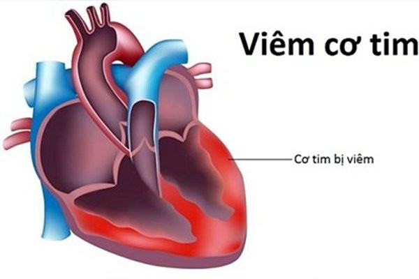 Bệnh viêm cơ tim có chữa được không?