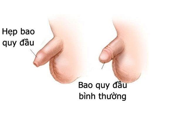 Bị hẹp bao quy đầu có nguy hiểm không? Cách chữa nào hiệu quả nhất?