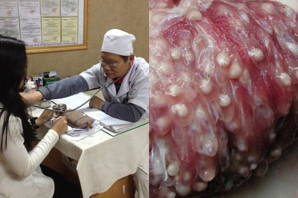 Bị nhiễm sán lợn có chữa khỏi hoàn toàn được không?