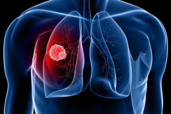 Biến chứng nguy hiểm của bệnh áp xe phổi? Các phương pháp điều trị phù hợp