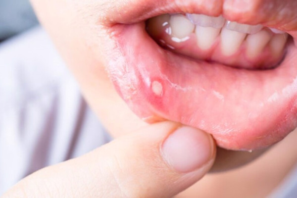 Các cách chữa nhiệt miệng đơn giản tại nhà