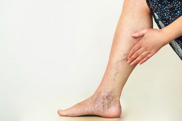 Các dấu hiệu nhận biết sớm bệnh giãn tĩnh mạch chân