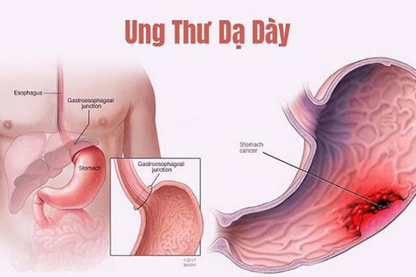 Các dấu hiệu nhận biết sớm bệnh ung thư dạ dày