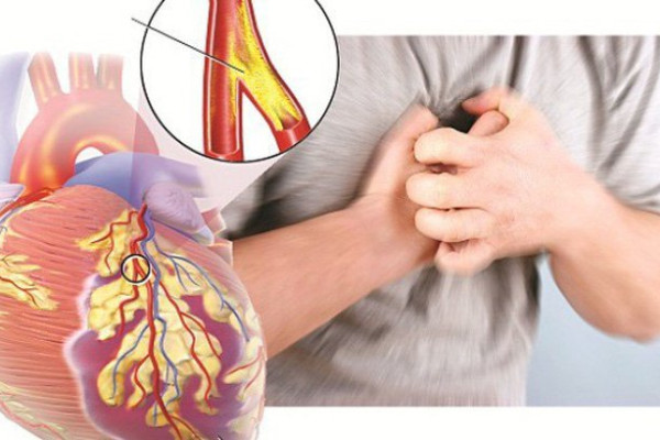 Các phương pháp điều trị bệnh tim thiếu máu cục bộ nguy hiểm