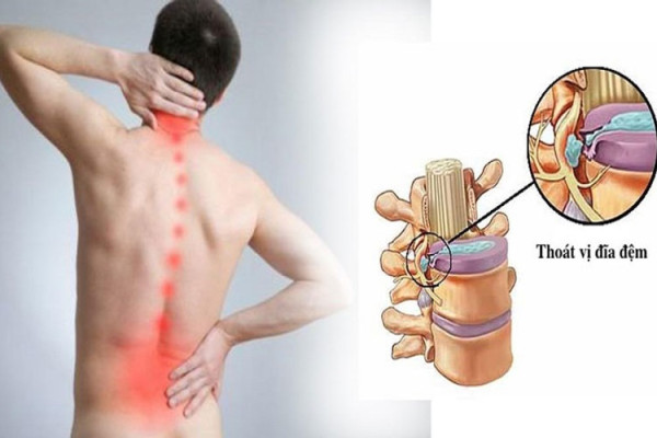 Các phương pháp điều trị thoát vị đĩa đệm hiệu quả hiện nay