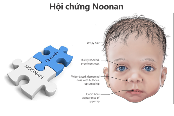 Các thông tin bạn nên biết về hội chứng Noonan