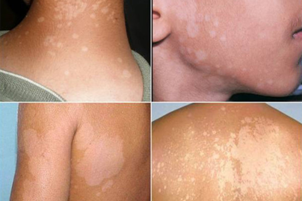 Cách điều trị lang ben bằng các phương pháp dân gian