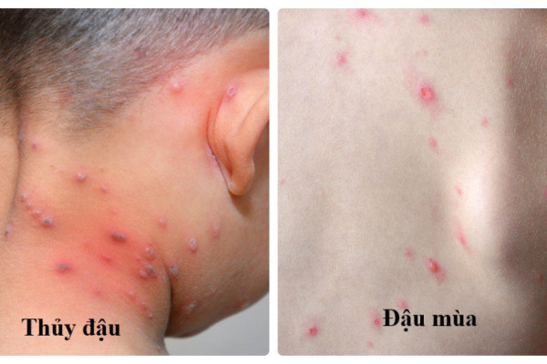 Cách phân biệt bệnh bệnh đậu mùa và thủy đậu