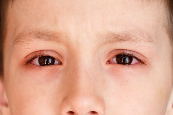 Chia sẻ các cách chăm sóc trẻ bị đau mắt đỏ mà phụ huynh nên biết