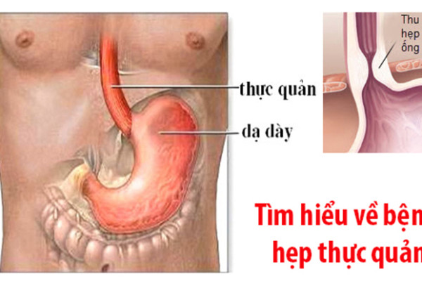 Có phương pháp nào để điều trị bệnh hẹp thực quản?