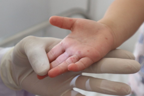 Đắk Lắk: Gần 290 ca mắc, 1 ca tử vong do tay chân miệng