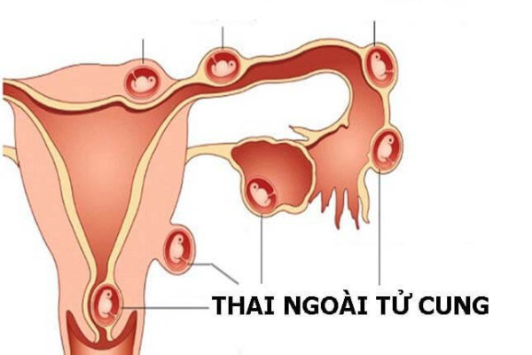 Dấu hiệu nhận biết mang thai ngoài tử cung và cách điều trị hiệu quả