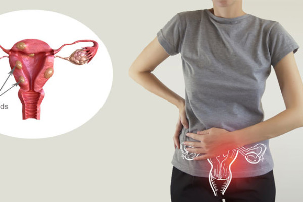 Dấu hiệu nhận biết sớm u xơ tử cung các chị em cần biết