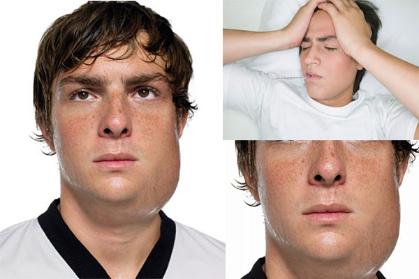 Dấu hiệu triệu chứng của bệnh quai bị biểu hiện như thế nào?