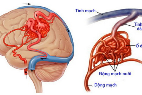 Dị dạng mạch não có nguy hiểm không? Các triệu chứng dị dạng mạch máu não