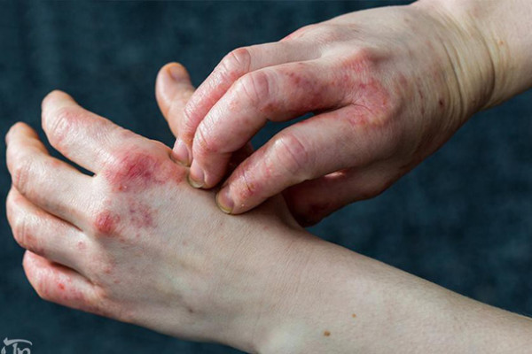 Eczema là bệnh gì? Nguyên nhân và cách điều trị hiệu quả nhất