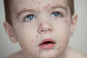 he-luy-khong-ngo-tu-phong-trao-anti-vaccine