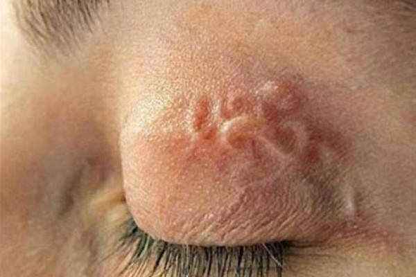 Bệnh ấu trùng sán lợn cần được điều trị và phòng ngừa như thế nào?