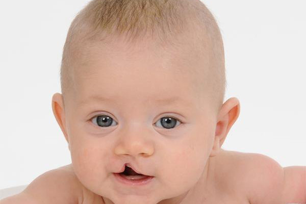 Hội chứng DiGeorge và những điều bạn chưa biết