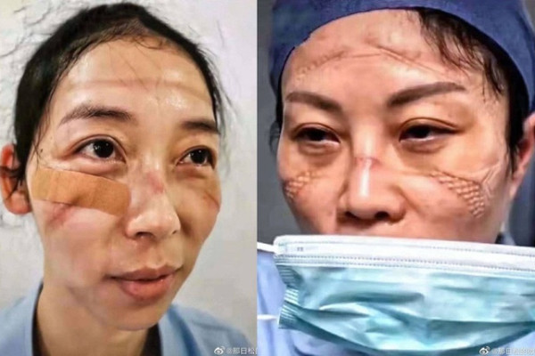 Khuôn mặt sưng đỏ, đầy vết hằn của y bác sĩ ở khu cách ly dịch corona