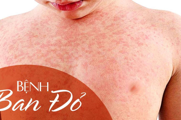 Làm thế nào để điều trị các triệu chứng của bệnh Lupus ban đỏ?