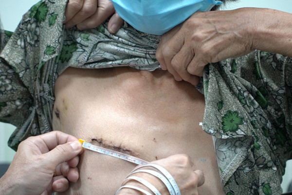 Lần đầu tiên tại Việt Nam: Áp dụng kỹ thuật phẫu thuật tim xâm lấn tối thiểu