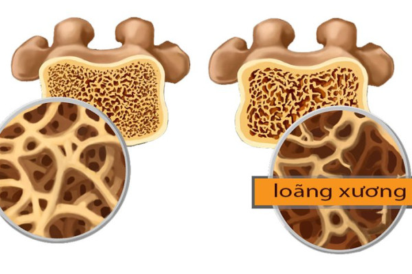 Loãng xương là gì? Loãng xương cấp độ 3 có nguy hiểm không?