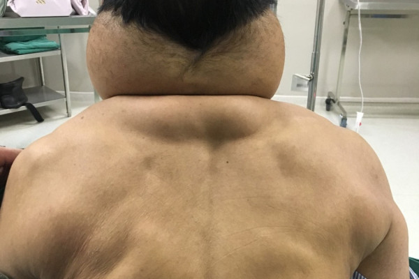 Một người đàn ông biến thành người khổng lồ sau nhiều năm nghiện rượu