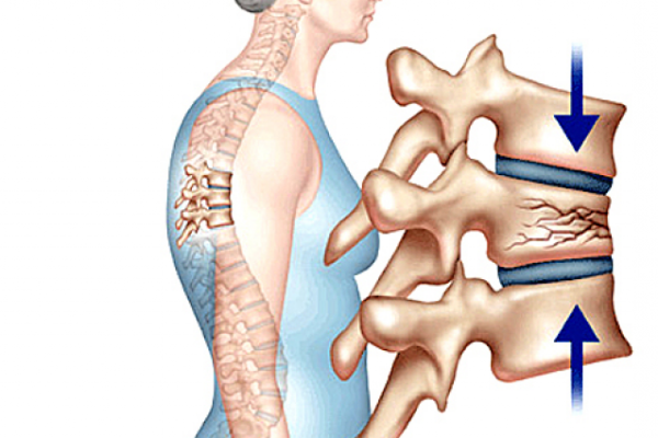 Nguyên nhân gây ra xẹp đốt sống là gì? Có chữa khỏi hoàn toàn bệnh được không?