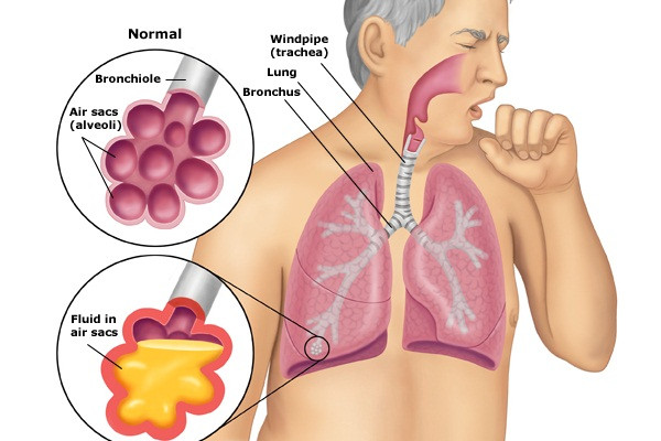 Nguyên nhân, triệu chứng thường gặp của bệnh phổi tắc nghẽn mãn tính